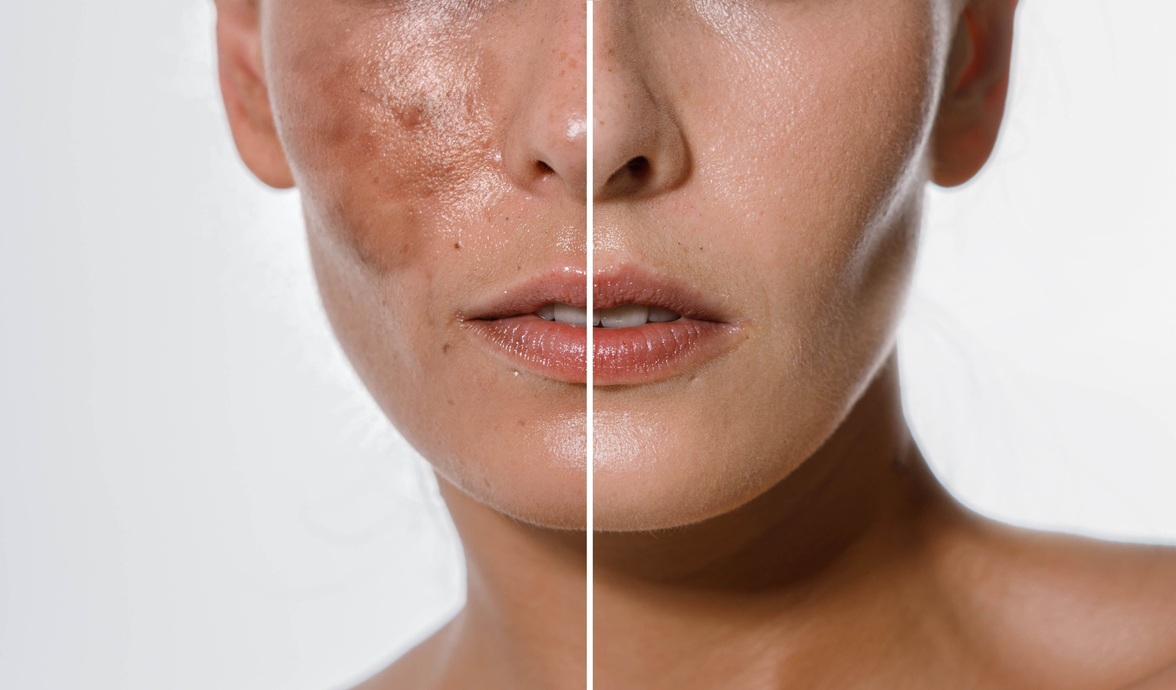 Why Our RPH Technology™ is Changing the Face of Brightening Serum Results